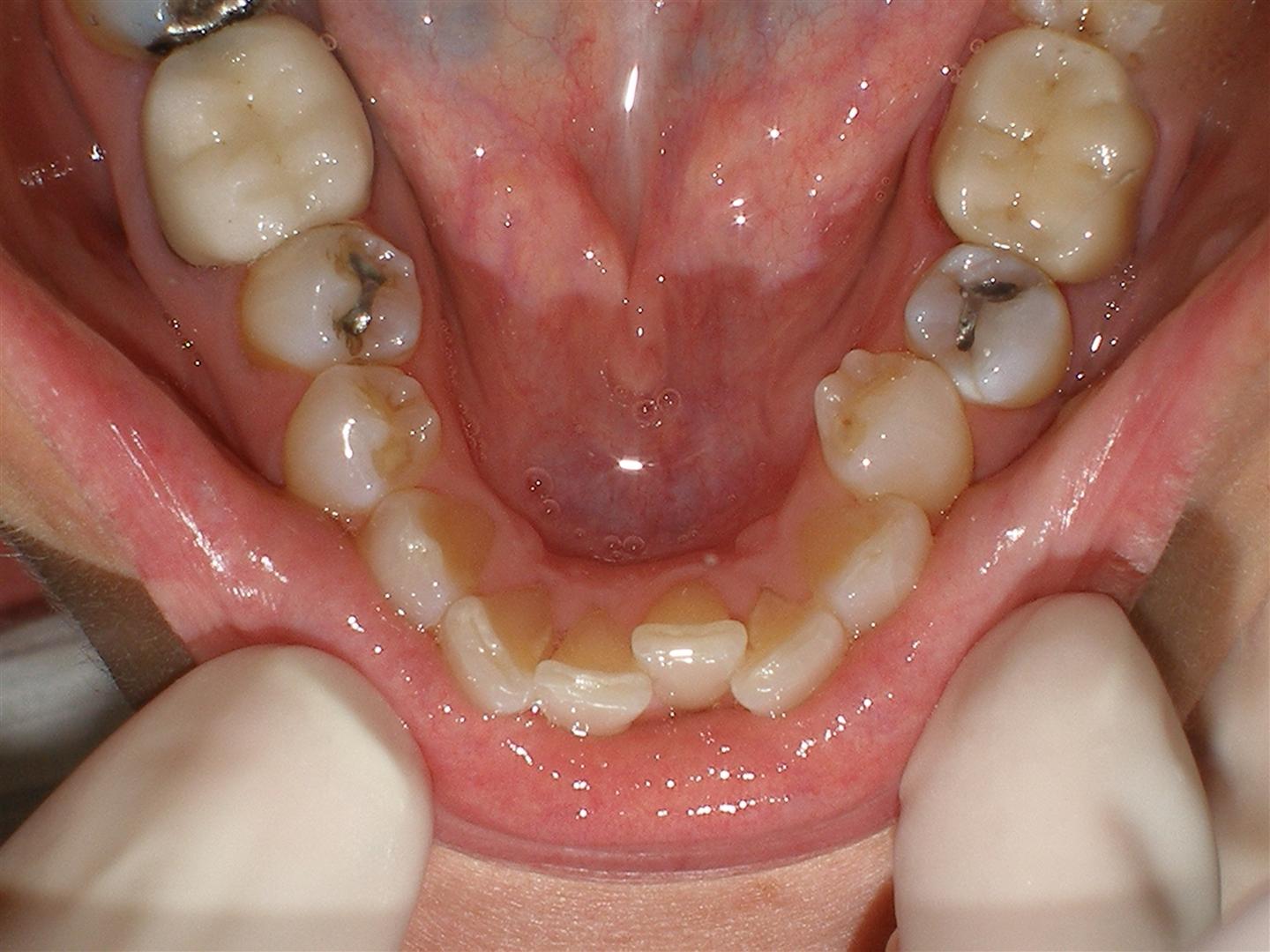 invisible braces
