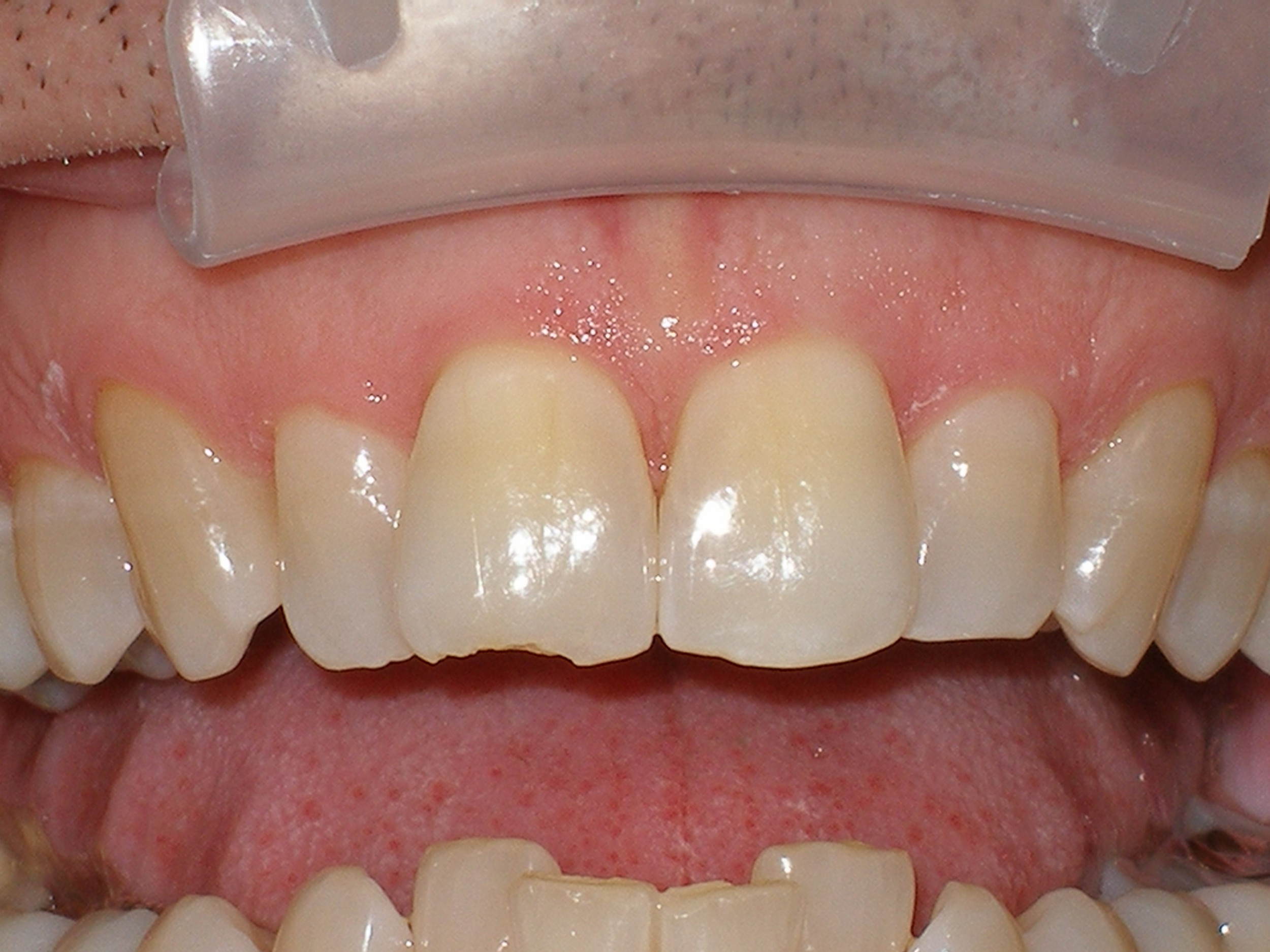 teeth reshaping
