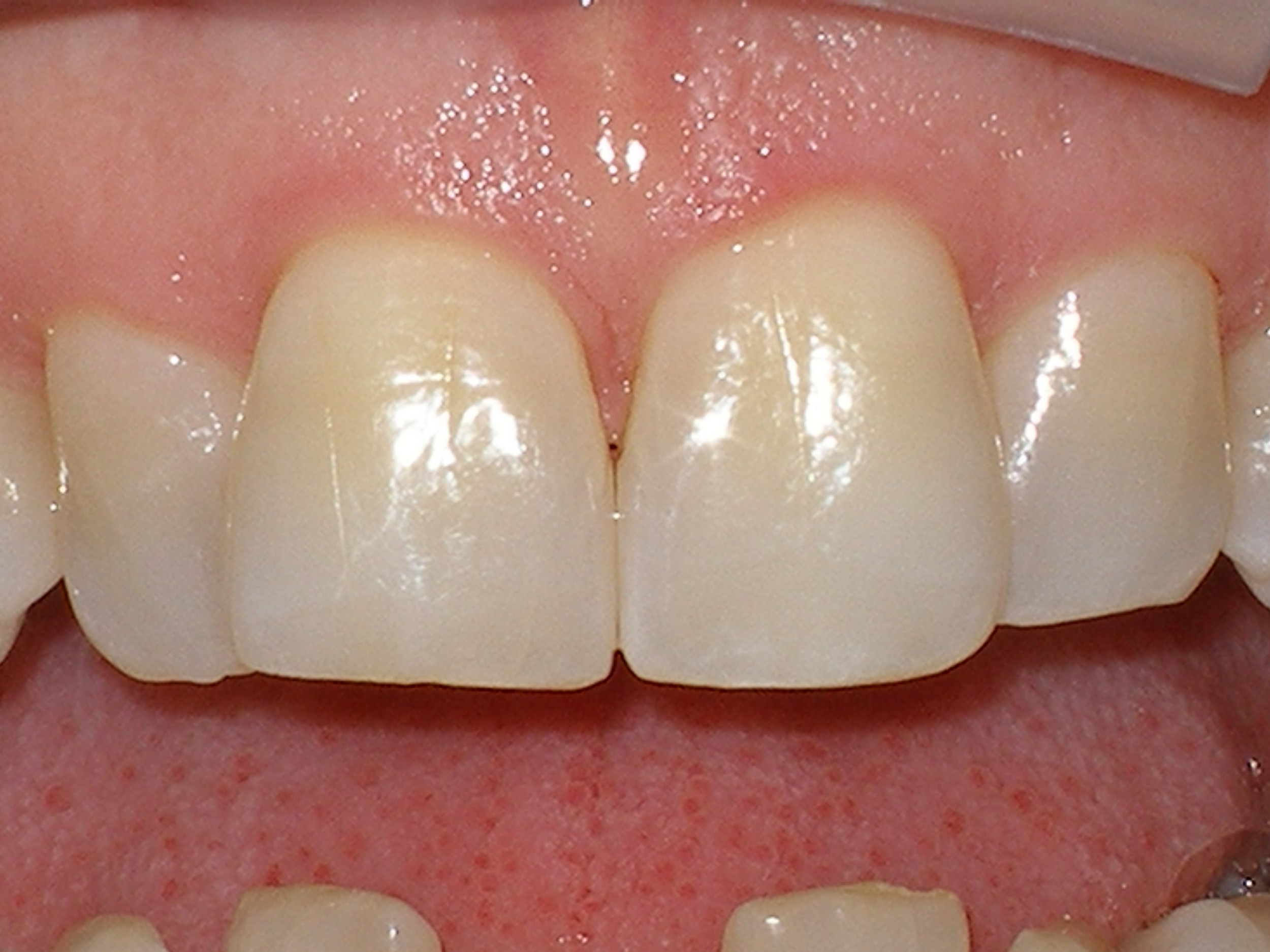 teeth reshaping