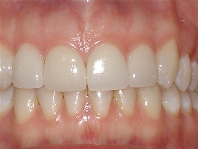 veneers