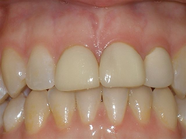 veneers